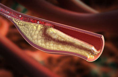 Does dental plaque cause atherosclerosis?